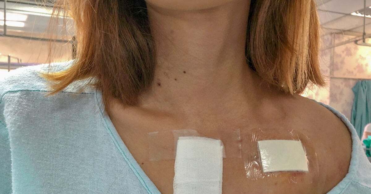 Placing A Pacemaker In Women