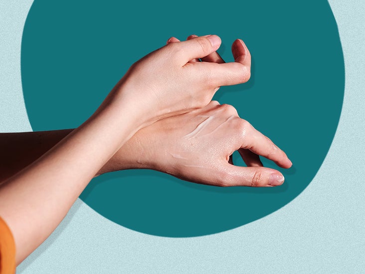 Salicylic Acid for Psoriasis Is It Right for You?