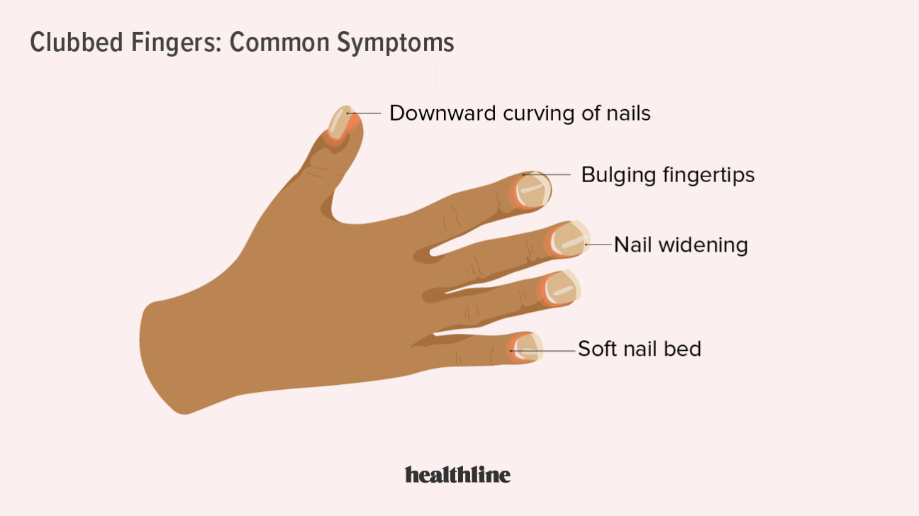 Clubbed Fingernails