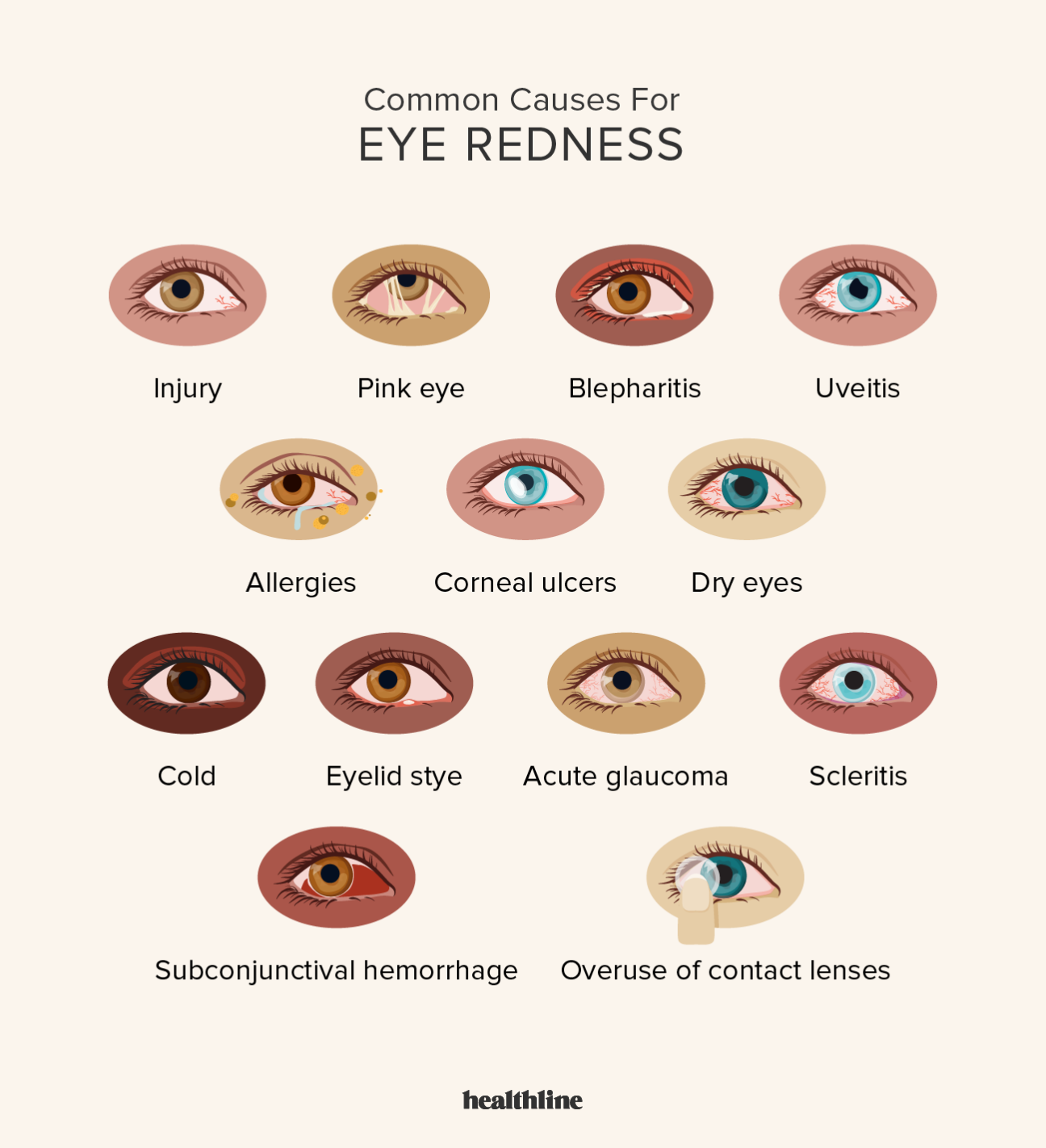 20 Causes, Symptoms, and Complications of Red Eyes