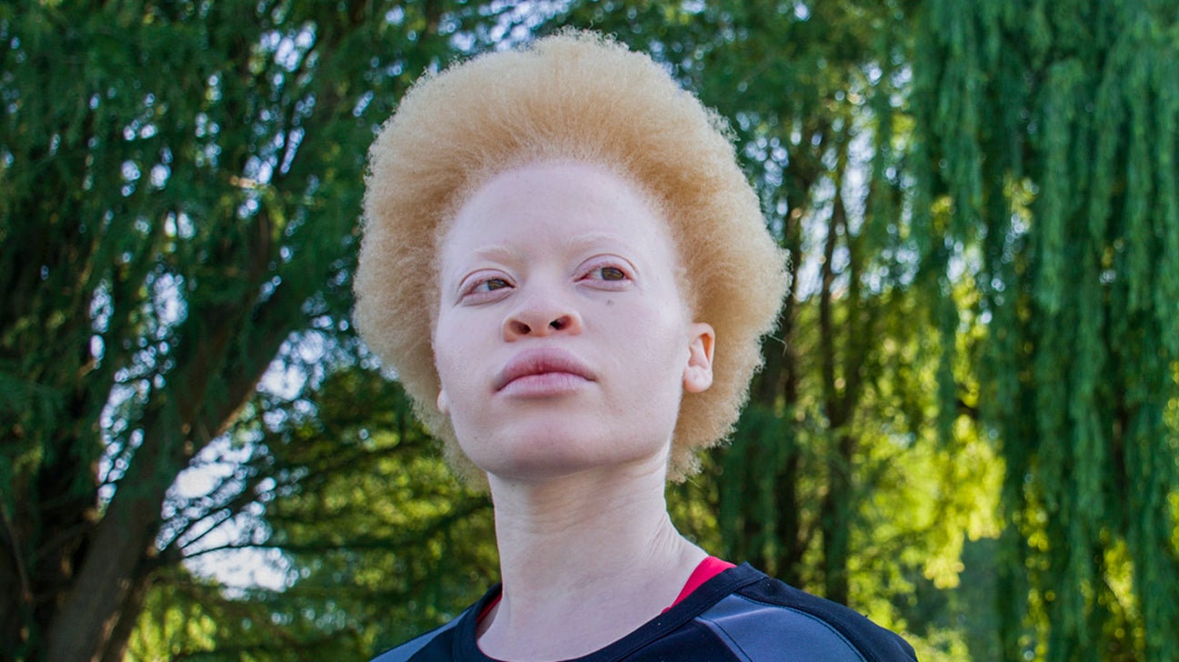 Albinism: Causes, Types, Pictures, Symptoms, and More