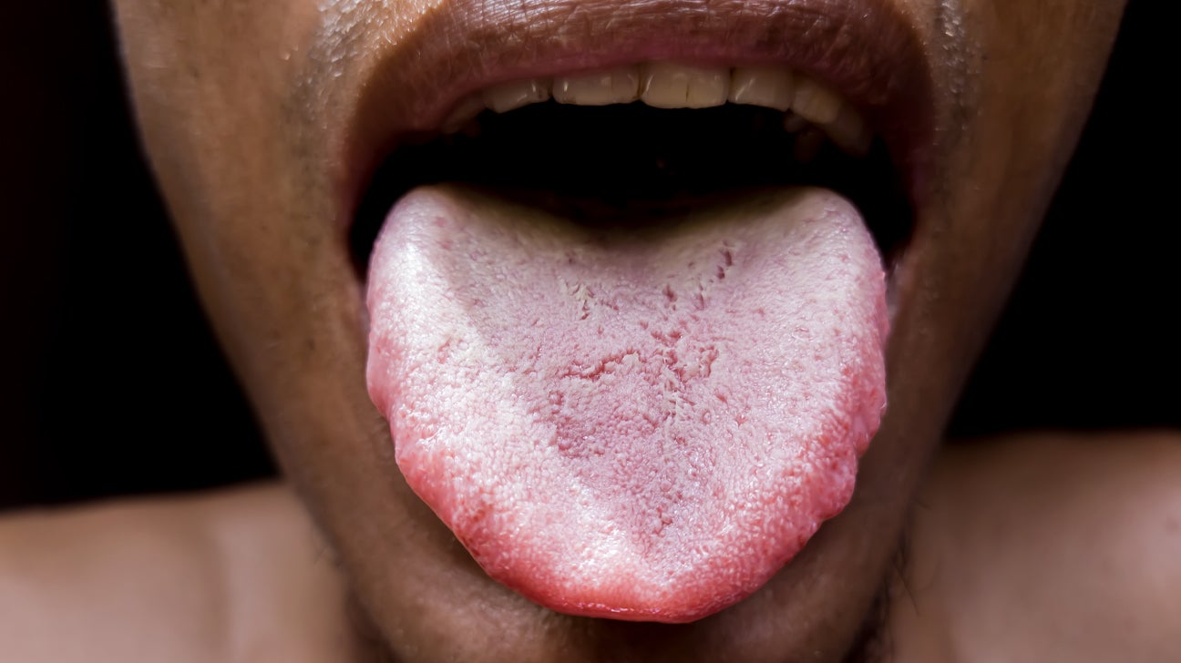 dehydration symptoms tongue