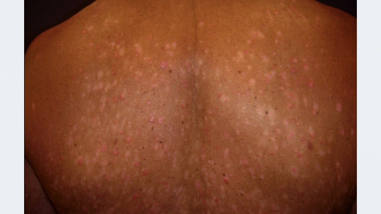 Guttate Psoriasis Pictures Causes Treatment And More