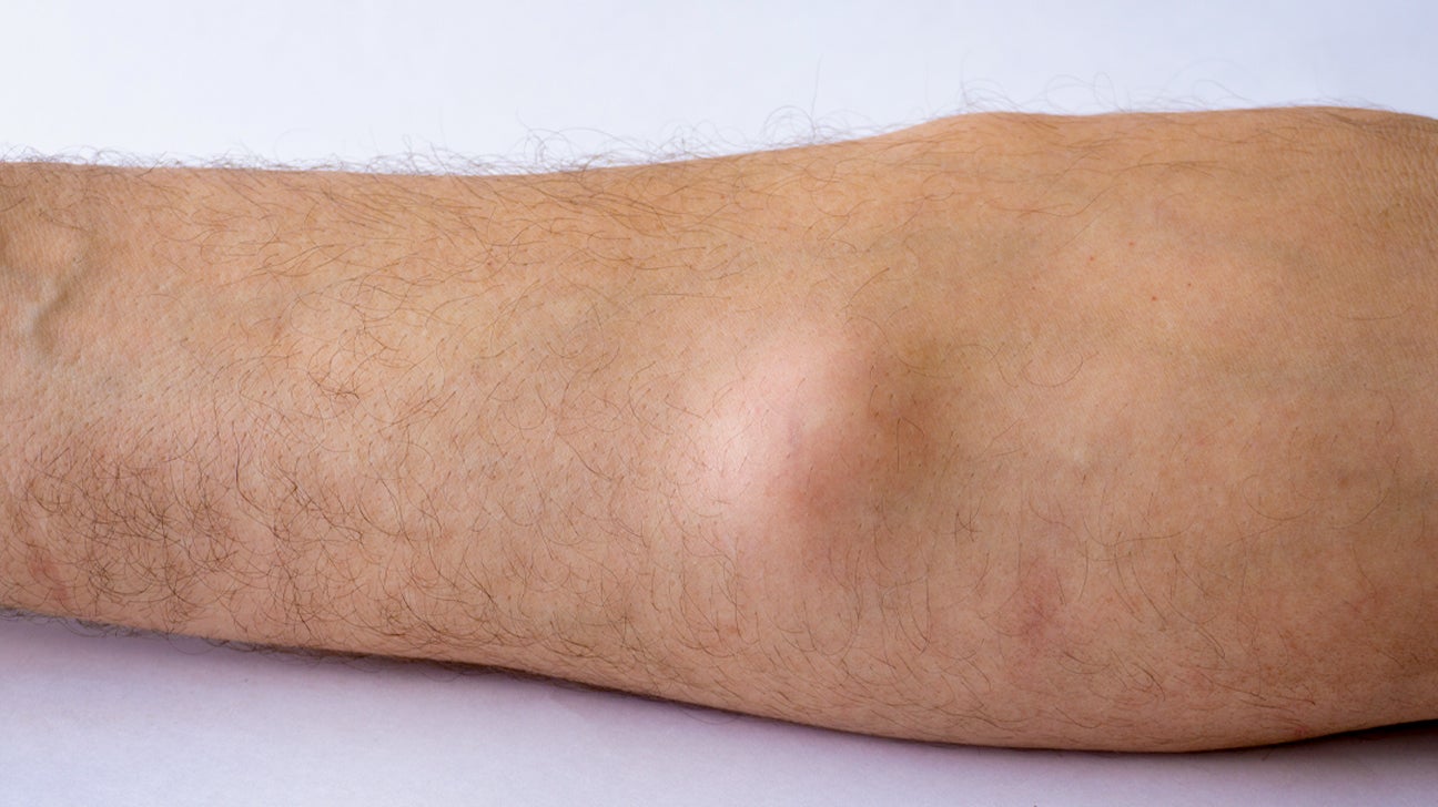 Can You Get A Lipoma On Your Lower Leg