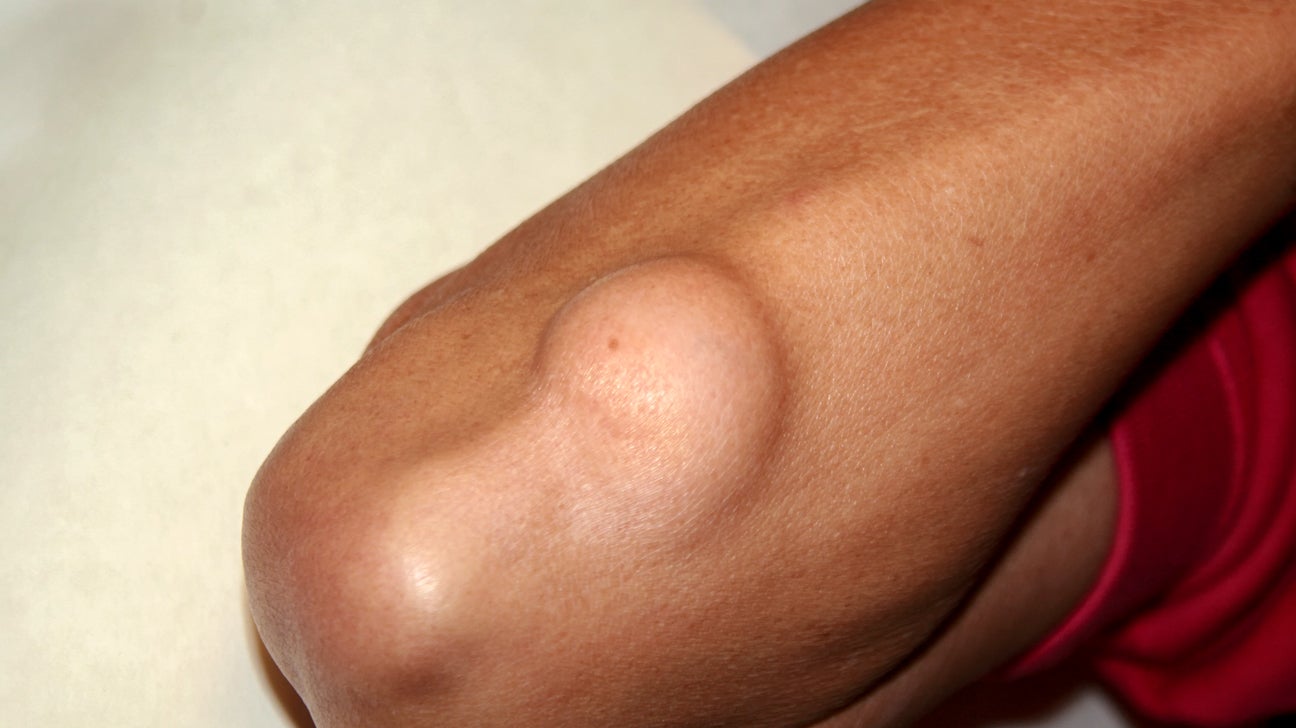 Lipoma: What It Is, Causes, Symptoms, Types, Treatment