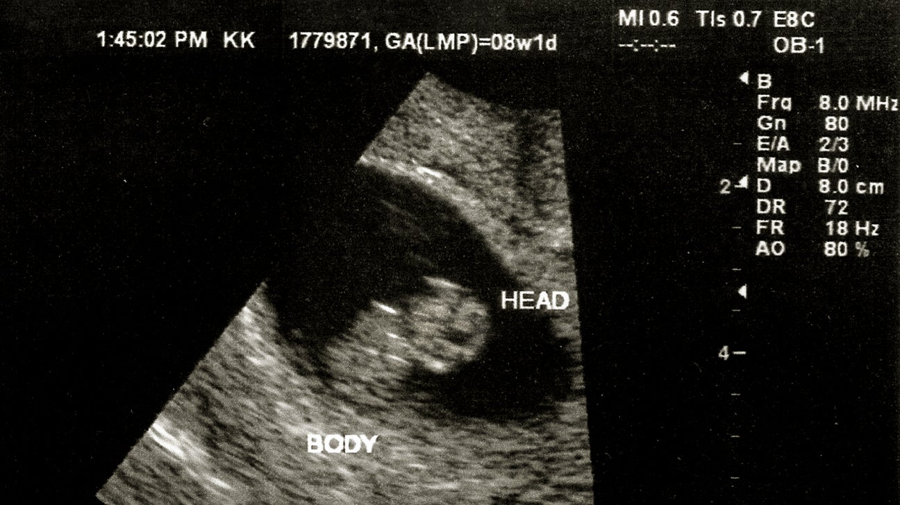 What Can I See On an 8-Week Ultrasound?