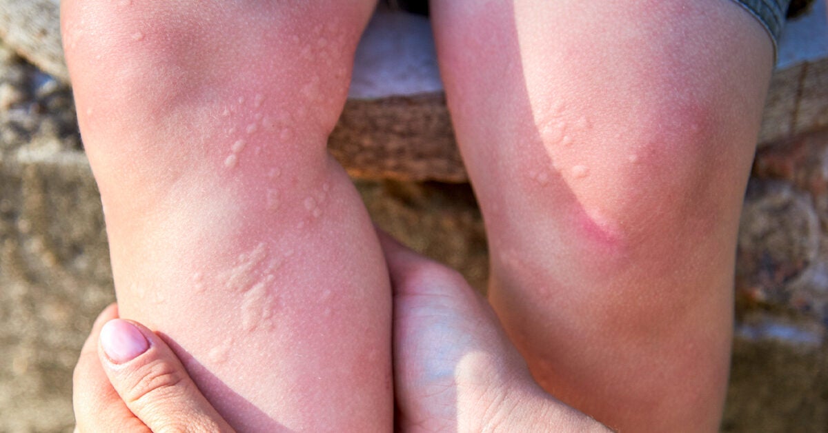 hives on hands