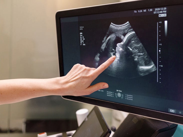 12 & 20 Week Pregnancy Ultrasound Baby Scan Print Photo Black Frame 
