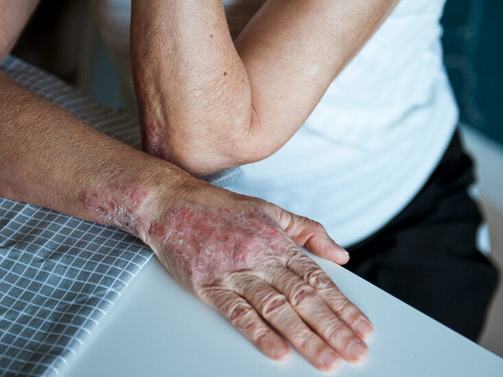 pikkelysömör milyen betegség hogyan kezelhető dermatitis pikkelysömör ekcéma kezelse