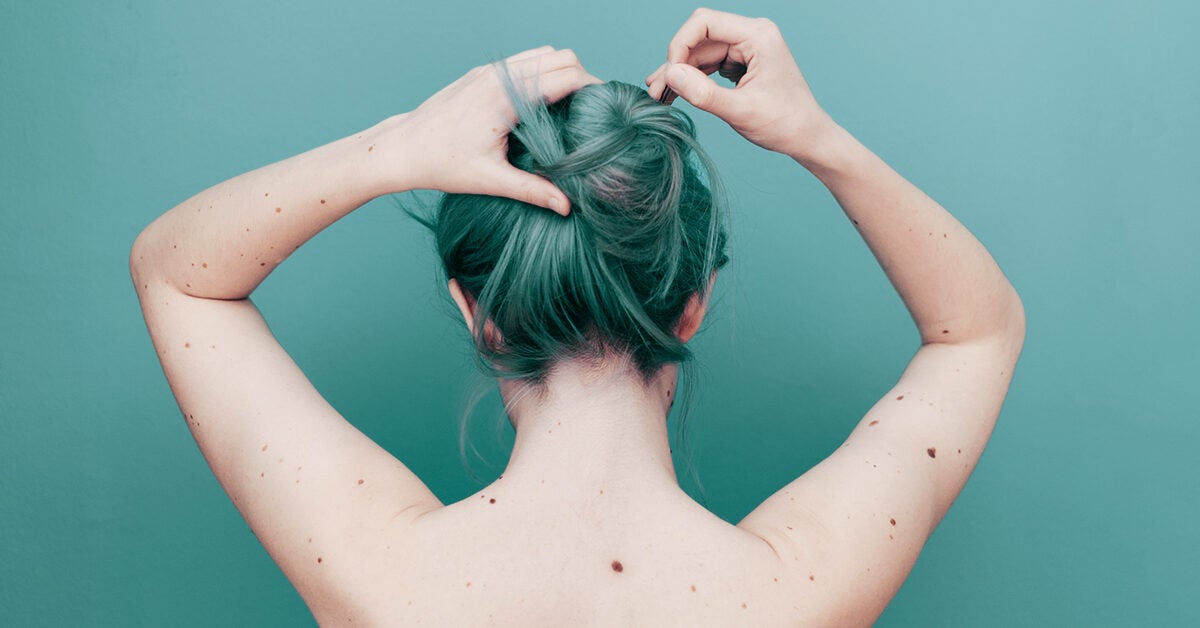 ABCDE Rule for Skin Cancer: What It Means and How to Use It