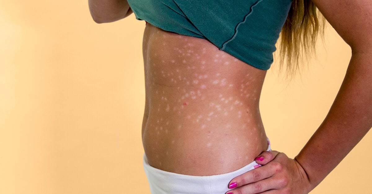 does guttate psoriasis leave scars