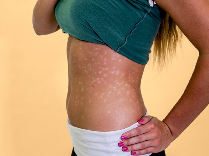 dermnet psoriasis guttate