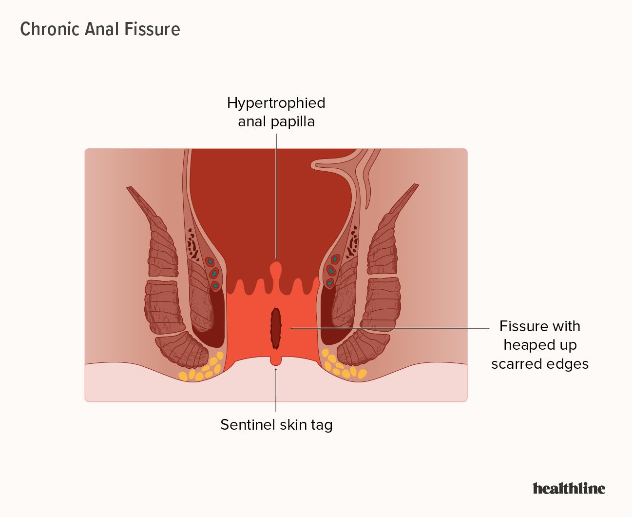Anal Fissure: What It Is, Symptoms, Causes & Treatment