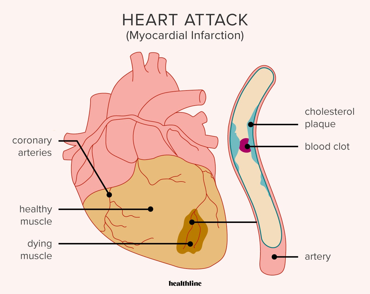 What Causes Heart Disease Symptoms At Eileen Porras Blog What Causes Heart Disease Symptoms At Eileen Porras Blog