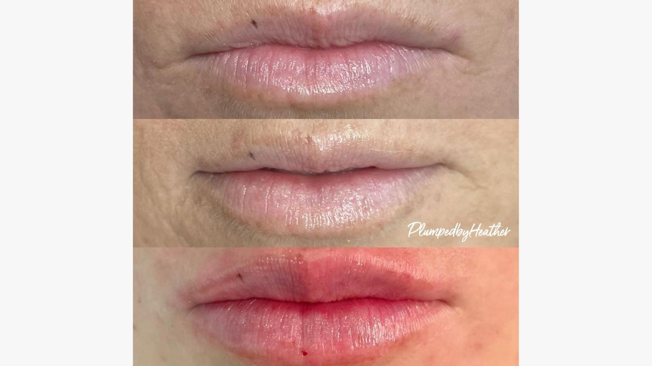Lip Fillers: What to Expect, Types, Benefits & Side Effects