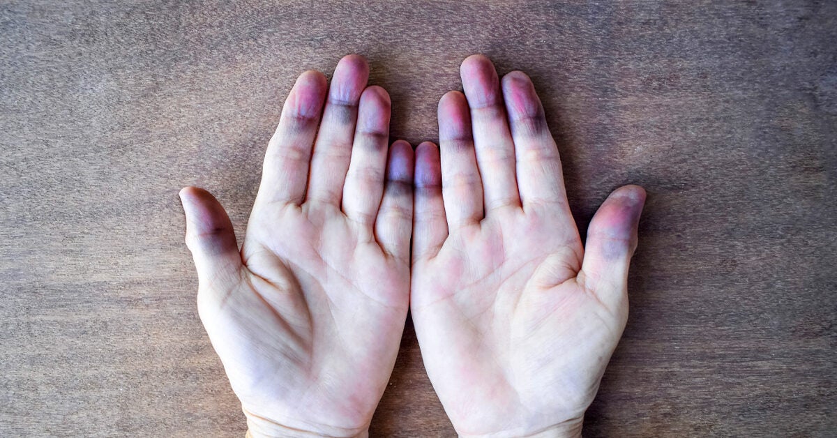 What You Need to Know About Peripheral Cyanosis (Blue Hands and Feet)