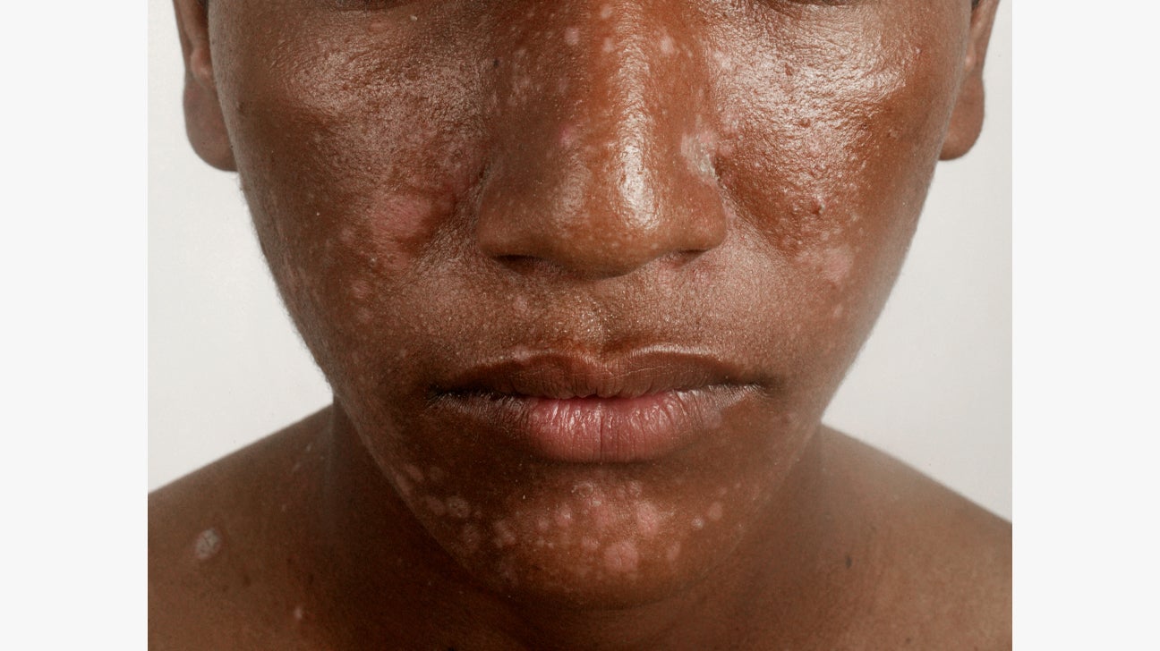 Psoriasis On The Face Symptoms Causes Treatment And More