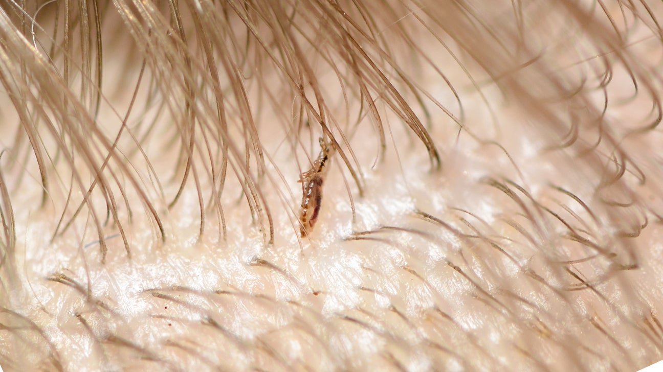 8. Understanding the Life Cycle of Head Lice in Blonde Hair - wide 4