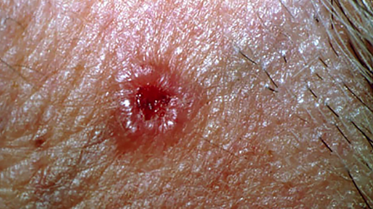 skin cancer types squamous cell carcinoma
