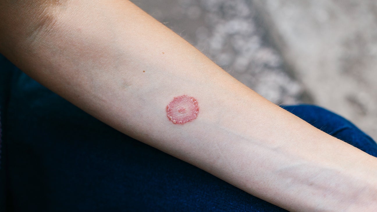 eczema uscata cu varicoza tricotaje de compresie cu venele varicoase pe timp de noapte