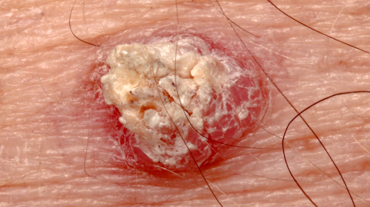 late squamous cell carcinoma