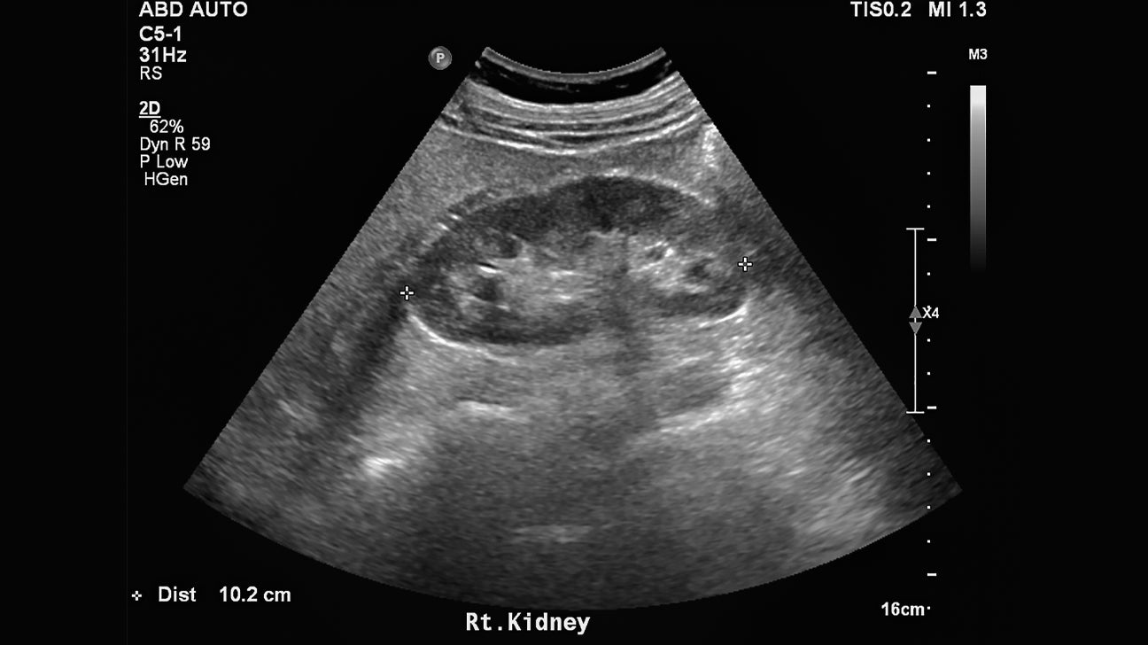 What Does Kidney Cancer Look Like On An Ultrasound Infoupdate