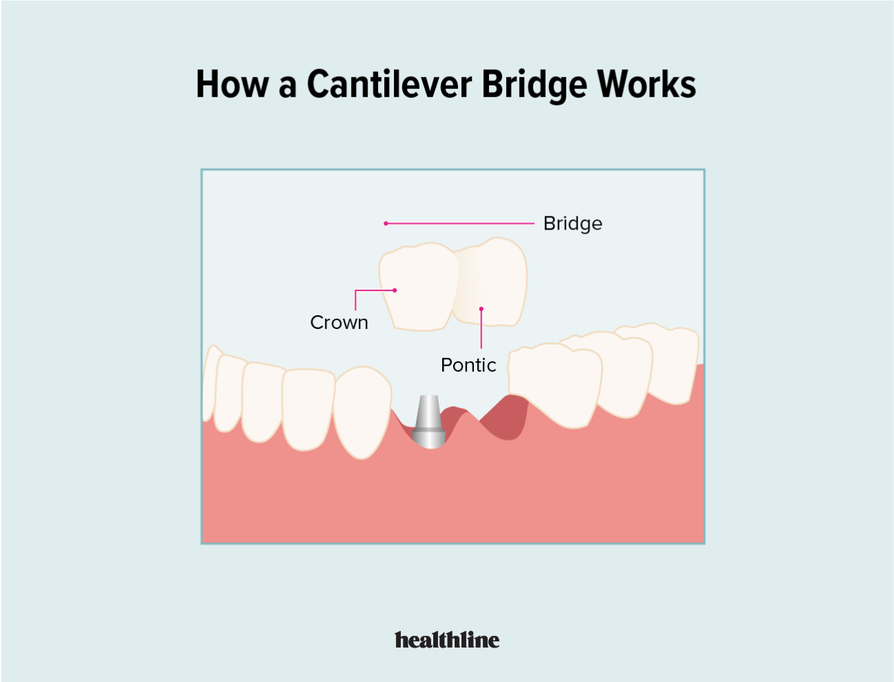Cantilever Dental Prostheses Single Implant Restorations With 