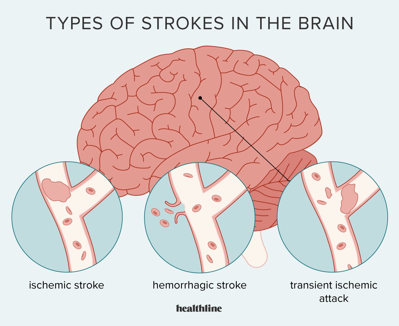 ischemic stroke vs hemorrhagic stroke