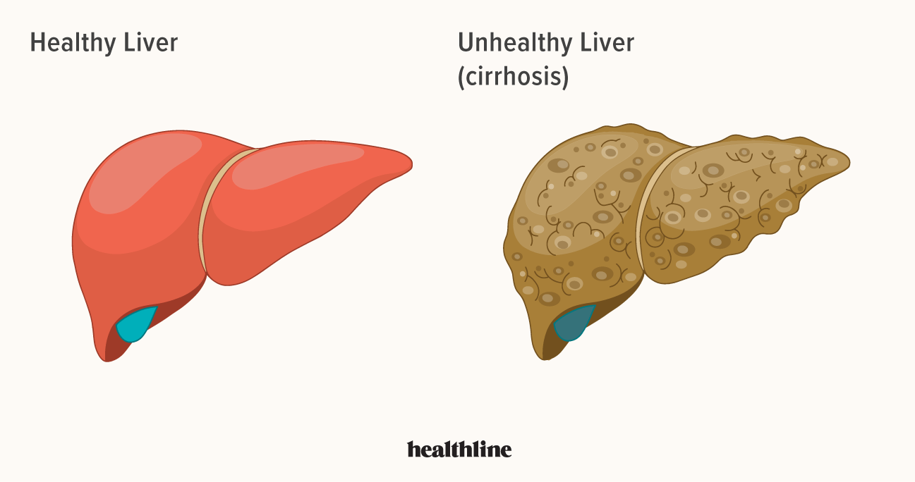 liver-disease-types-of-liver-problems-causes-and-more