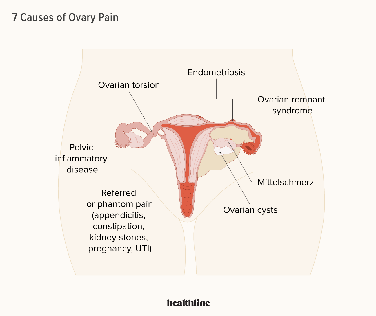 What are the symptoms of an ovarian cyst bursting, and is it