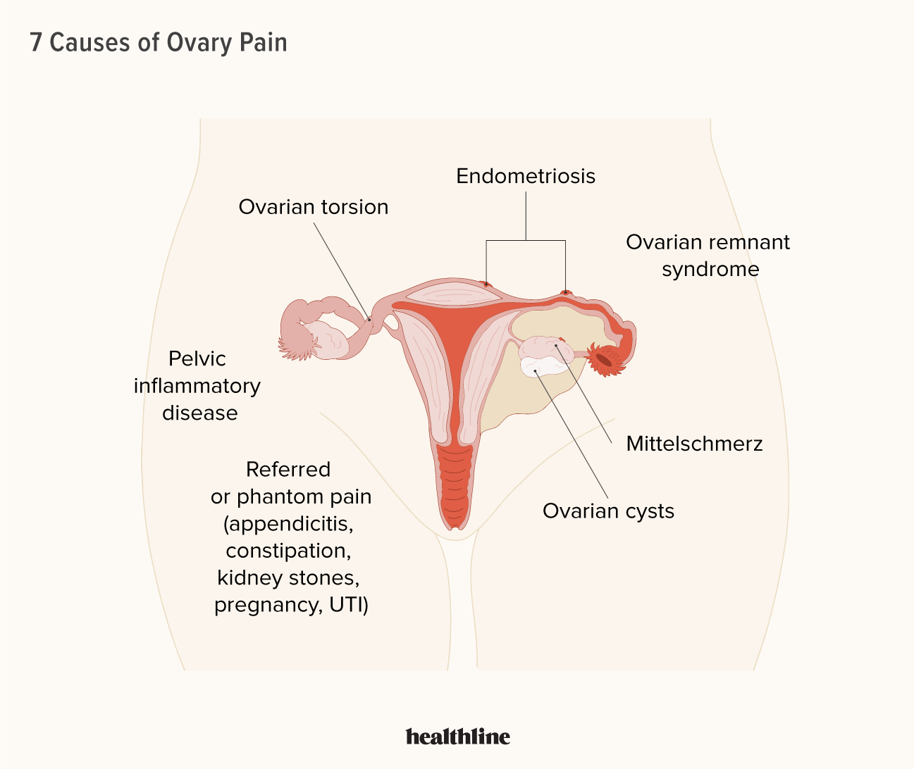 Ovarian Cyst Rupture – symptoms and causes