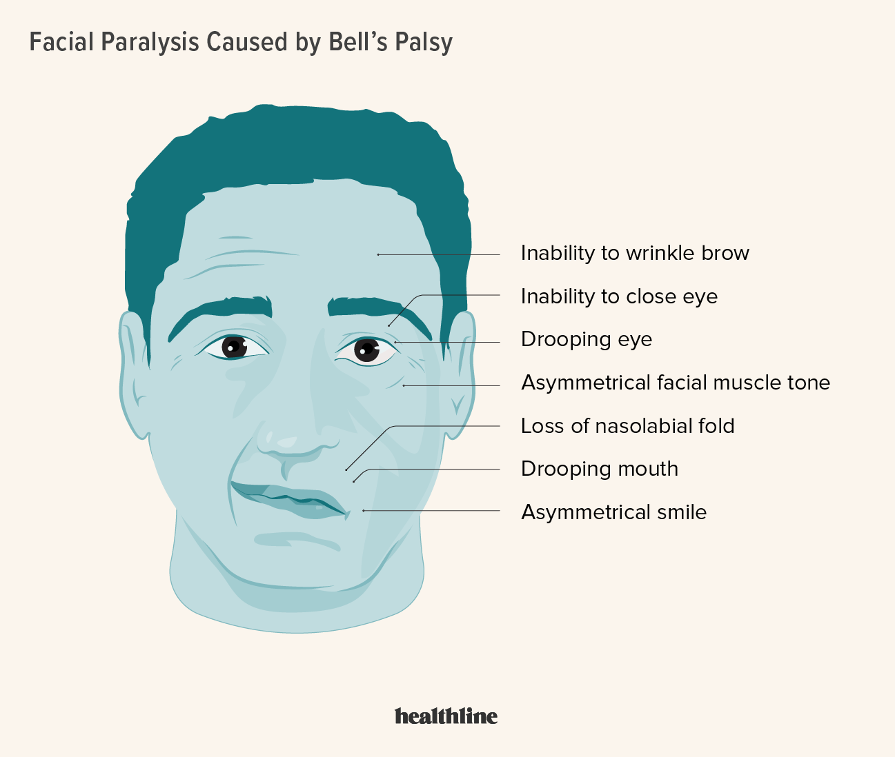 Bells Palsy Causes Symptoms Diagnosis Treatment Outlook