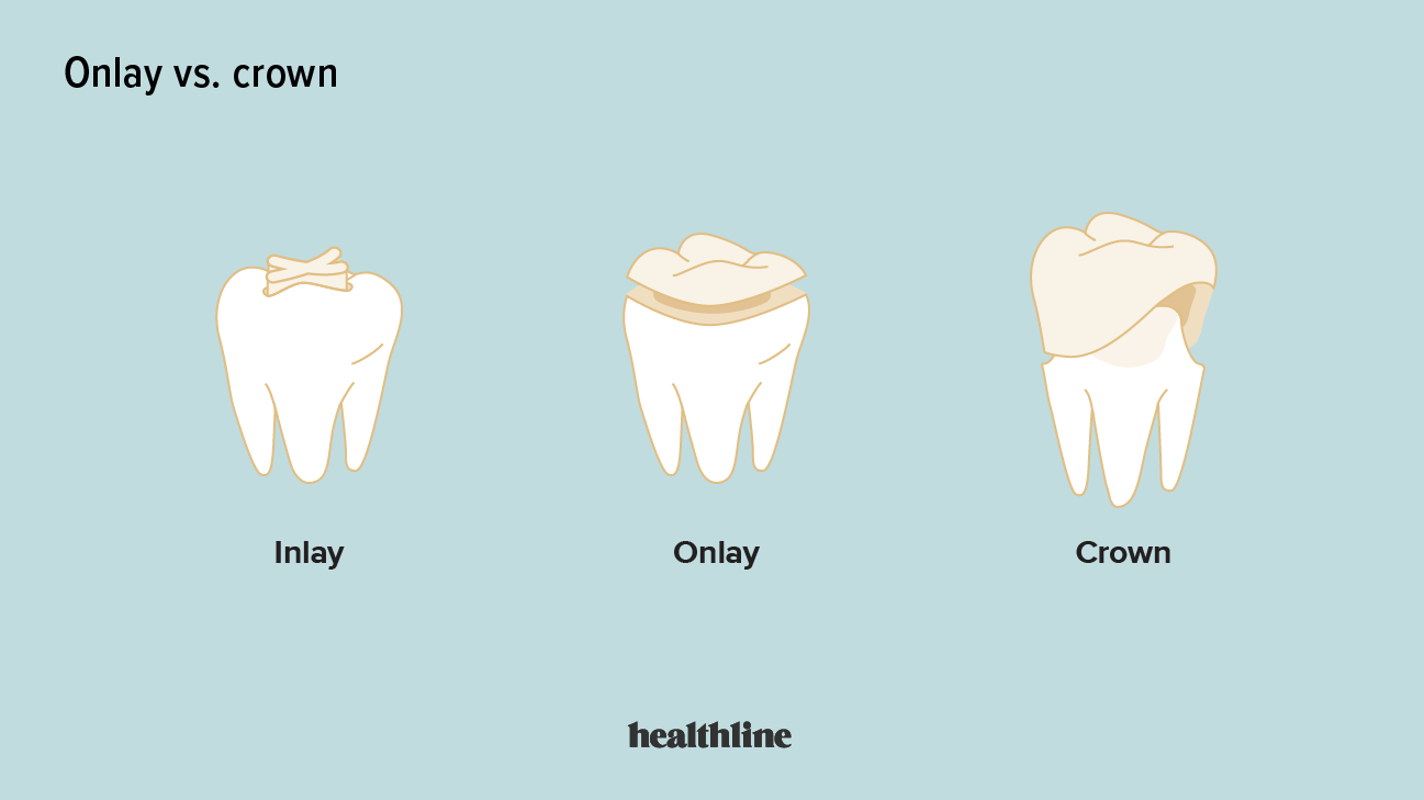Dental Crowns Vs Dental Onlays What You Need To Know