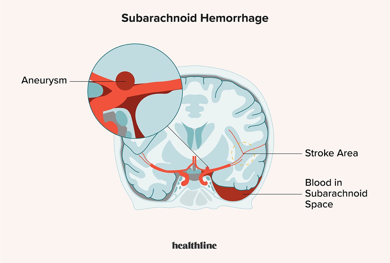 Brain Hemorrhage Recovery Time, Causes, and Symptoms