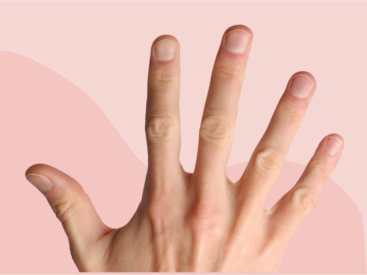 Brittle Nails: Causes, Treatment, and Prevention