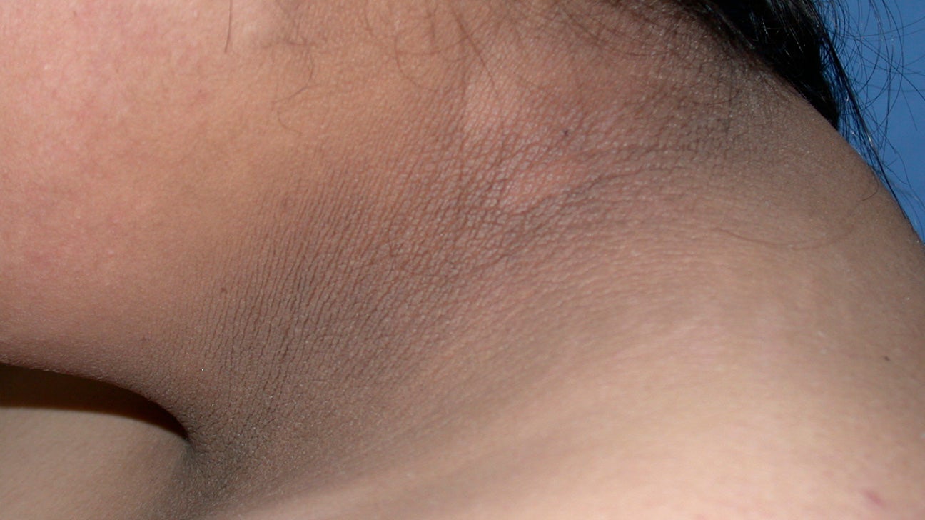 Dark mark under breast area