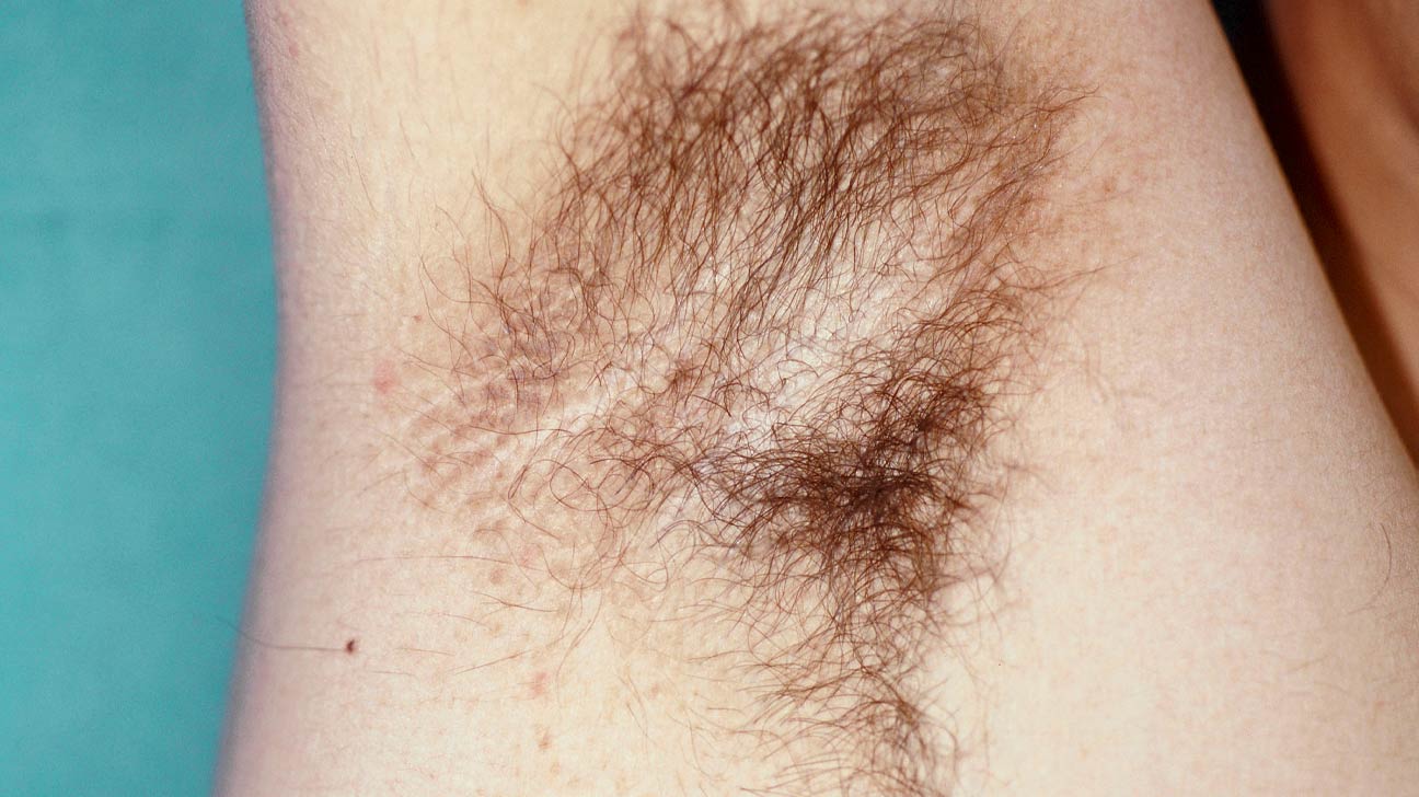 Acanthosis Nigricans Condition, Treatments and Pictures for Adults -  Skinsight
