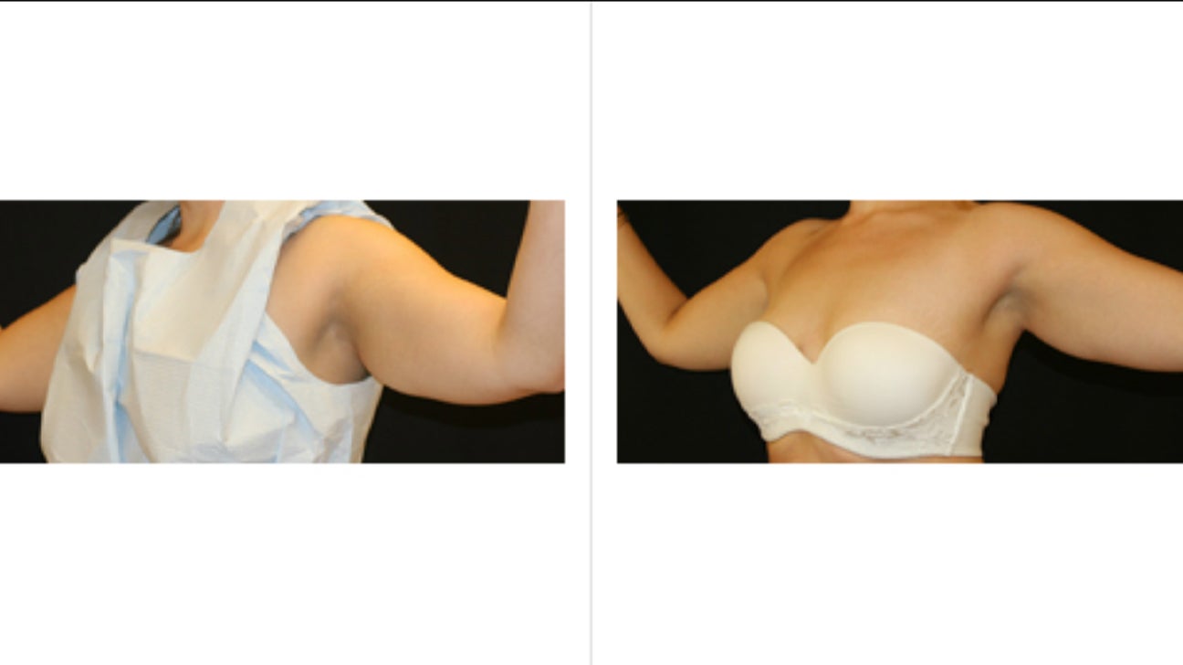Liposuction (Liposculpture) to Bra Fat & Axillary Wings 