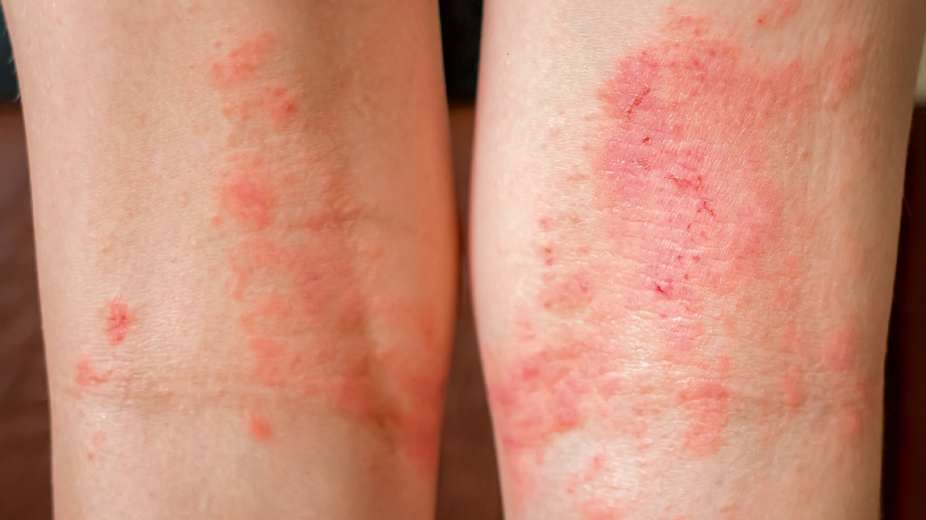 Fremskreden dukke udledning Dermatitis: Types, Symptoms, Causes, Treatments, and More