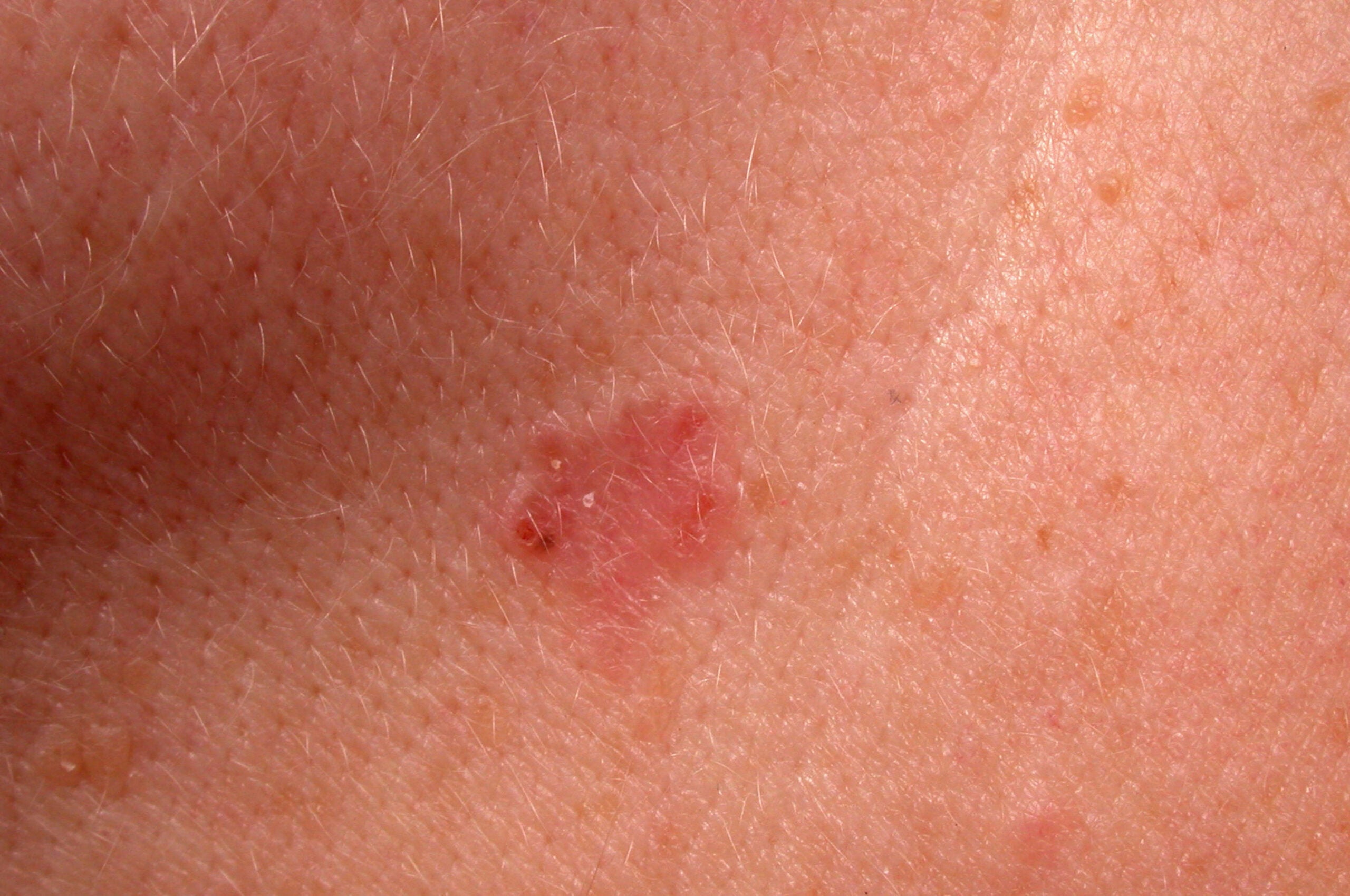 Warning Signs of Skin Cancer: Pictures, Diagnosis & More