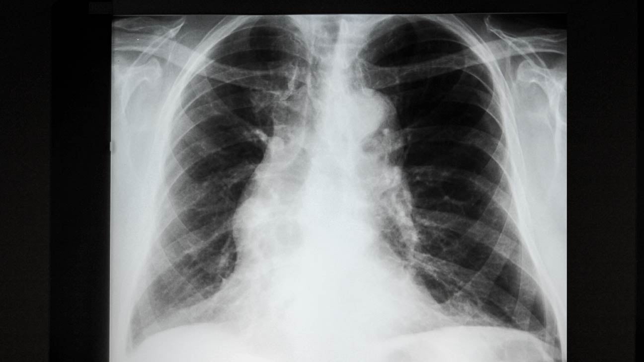baby chest x ray tube