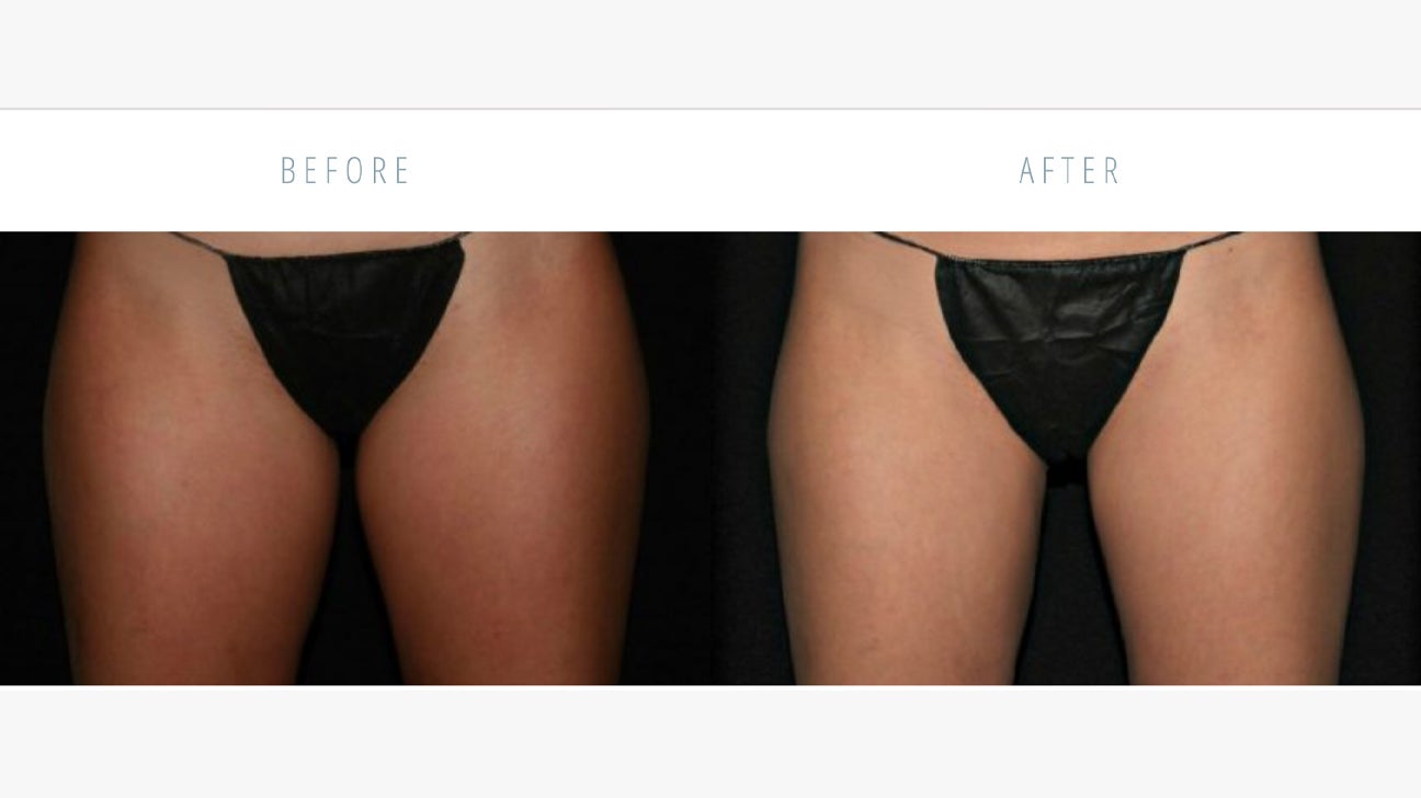 What's your advice for stuff to do and not do after liposuction? - Quora