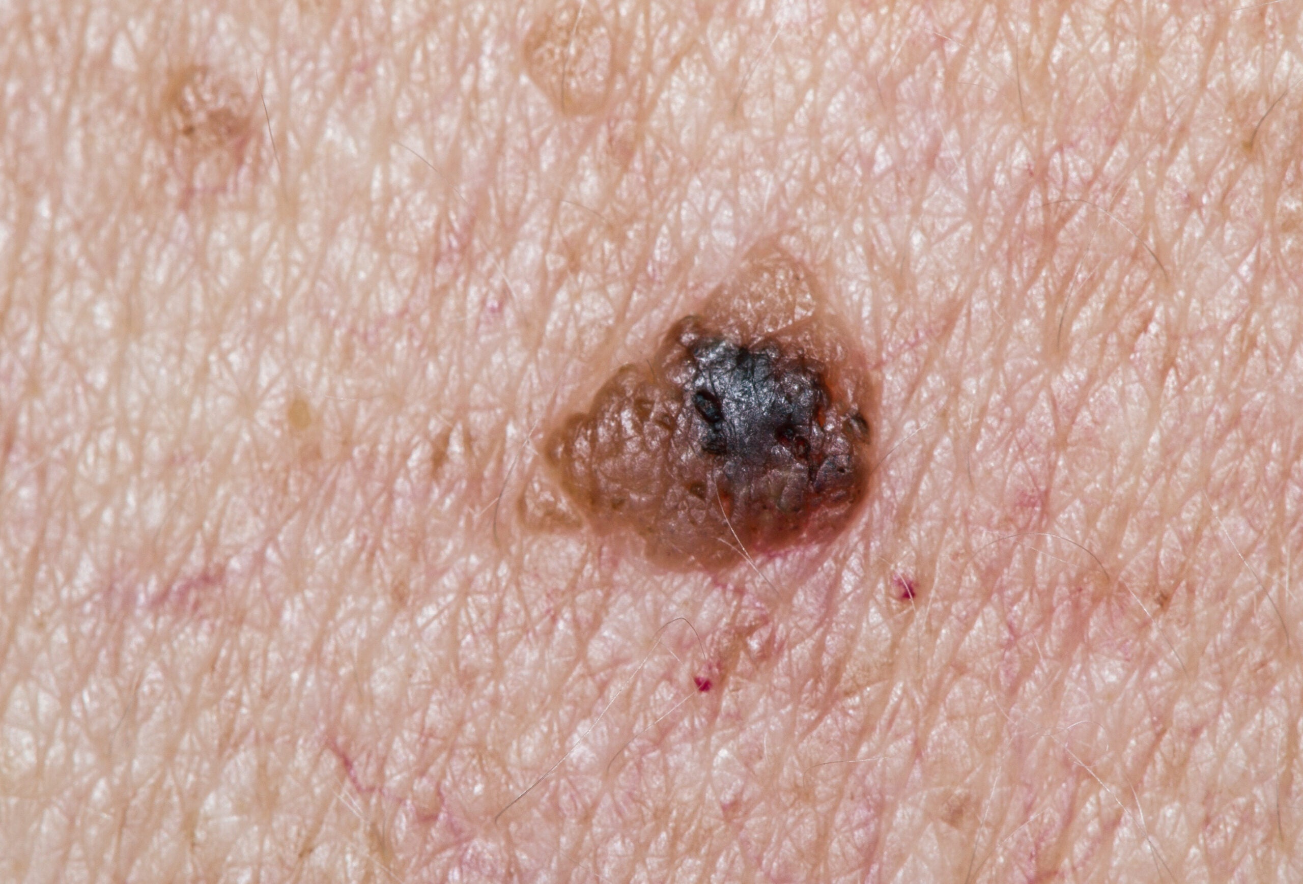 Common Skin Mole