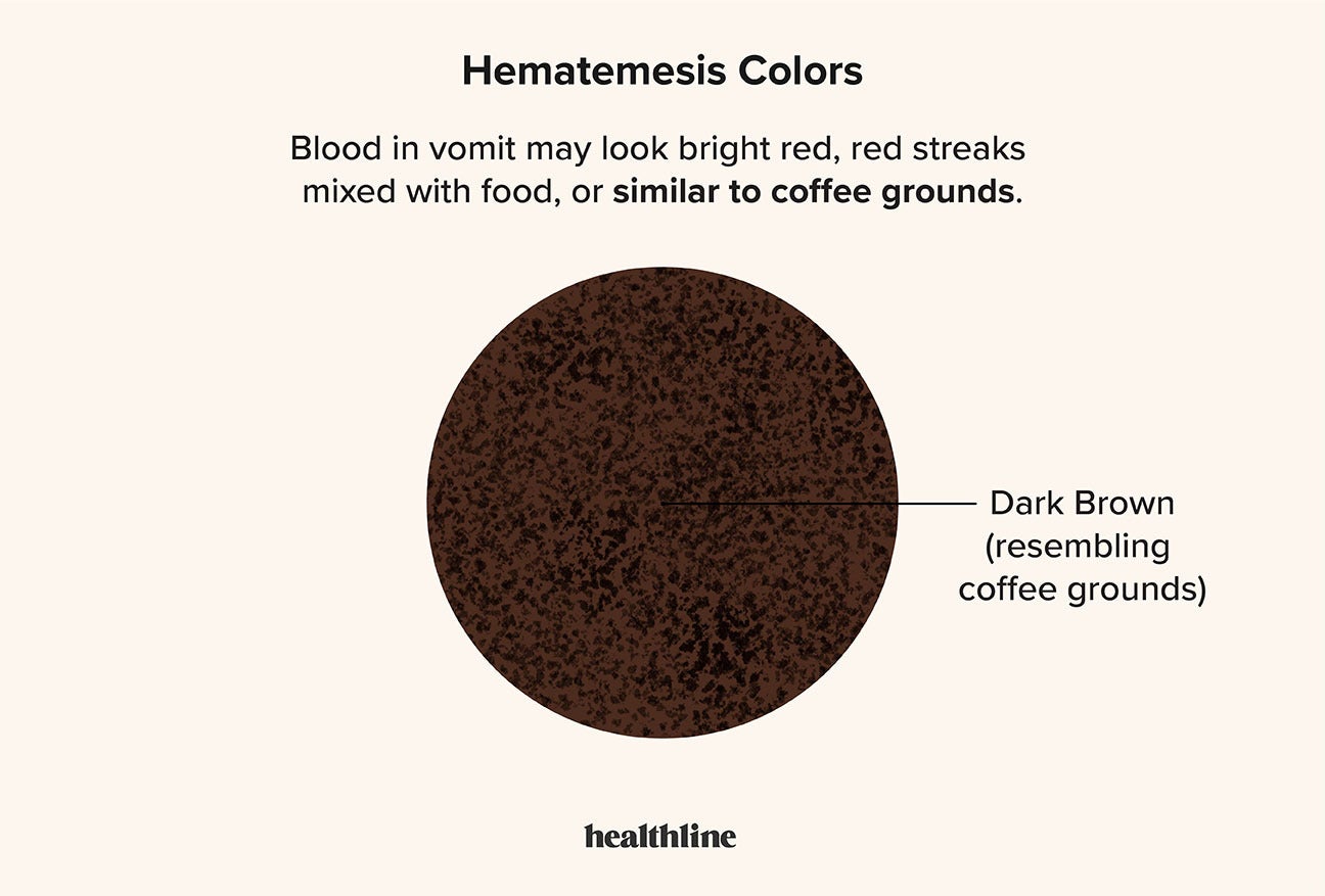 Vomiting Blood (Hematemesis): Causes, Symptoms & Treatment
