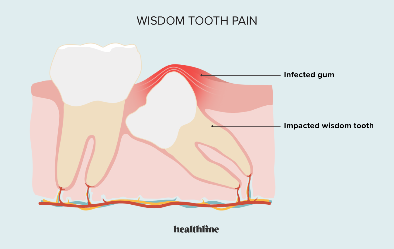 Wisdom Tooth Pain Relief Treatment And More