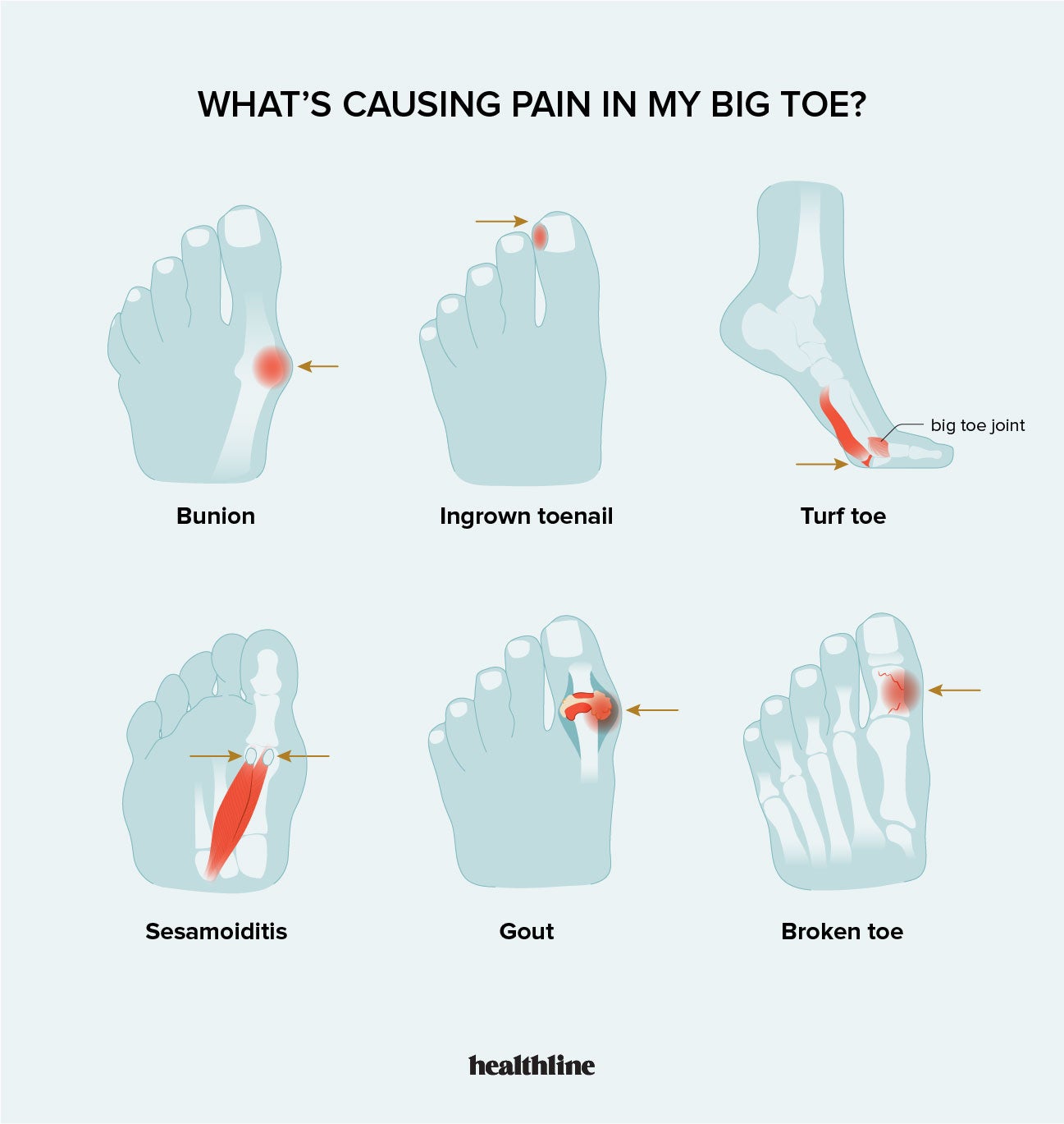 Causes Of Sharp Pain In Big Toe And When To Contact A Doctor