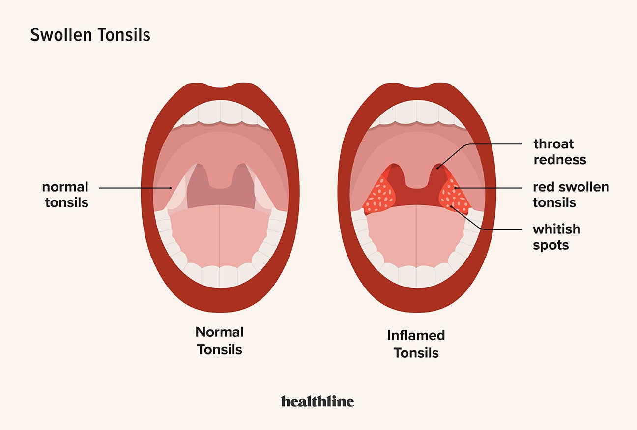 Swollen Tonsils Tonsillitis Symptoms Causes And More