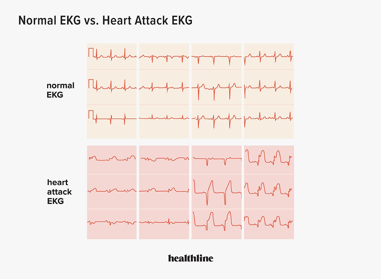 Heart Attack Ekg: Can An Ekg Detect A Previous Heart Attack?