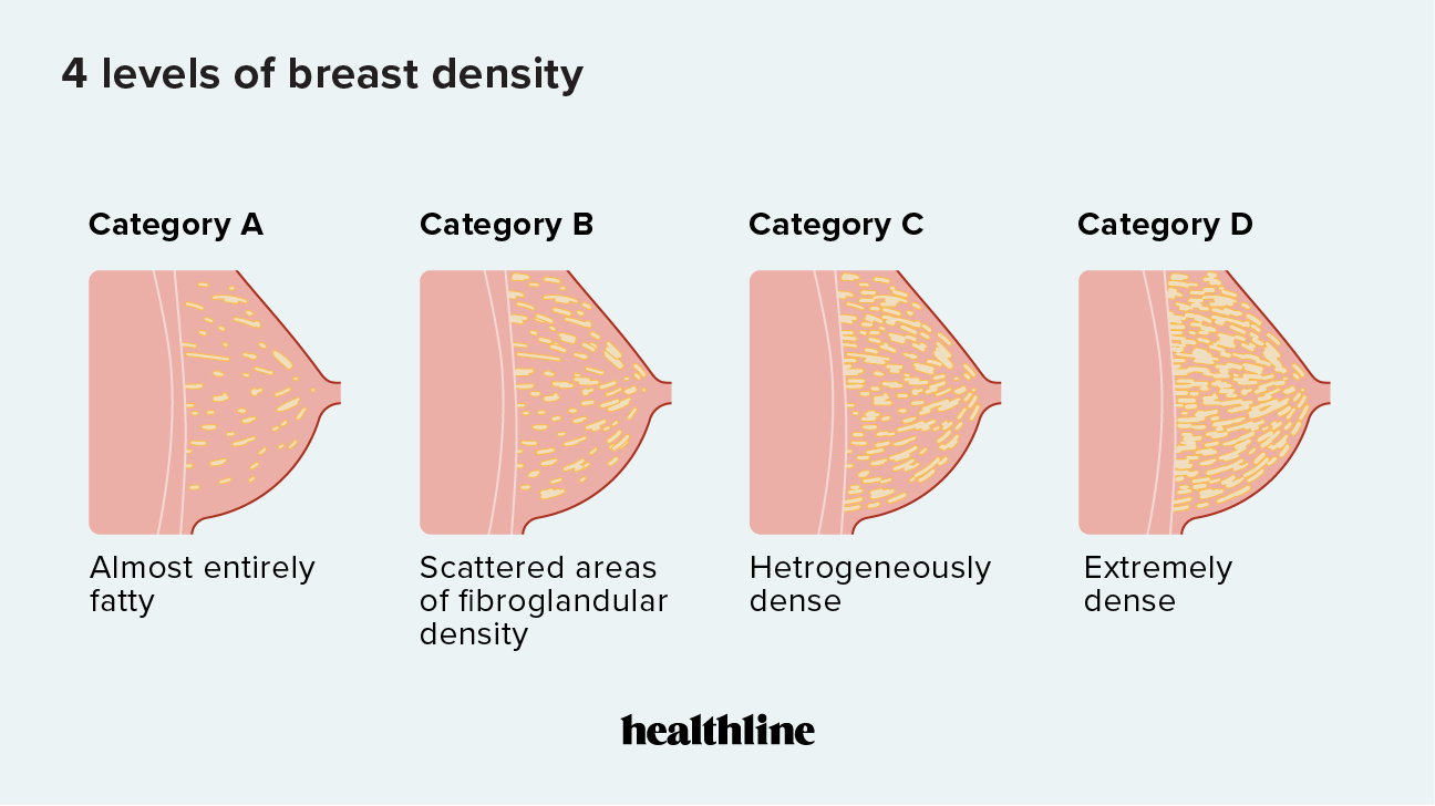 Dense breast' definition varies widely