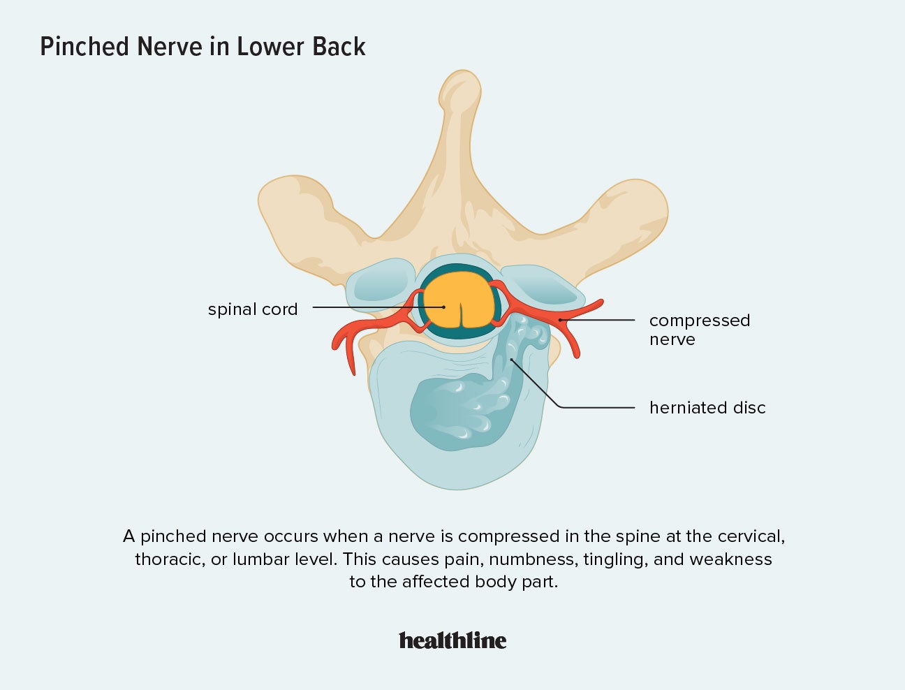 Pinched nerve in neck: Symptoms, causes, treatment, and more